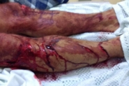Homem fica ferido ap�s agress�es e golpes de fac�o em Gaspar