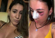 Advogada catarinense publica fotos com nariz quebrado e denuncia agress�o de ex
