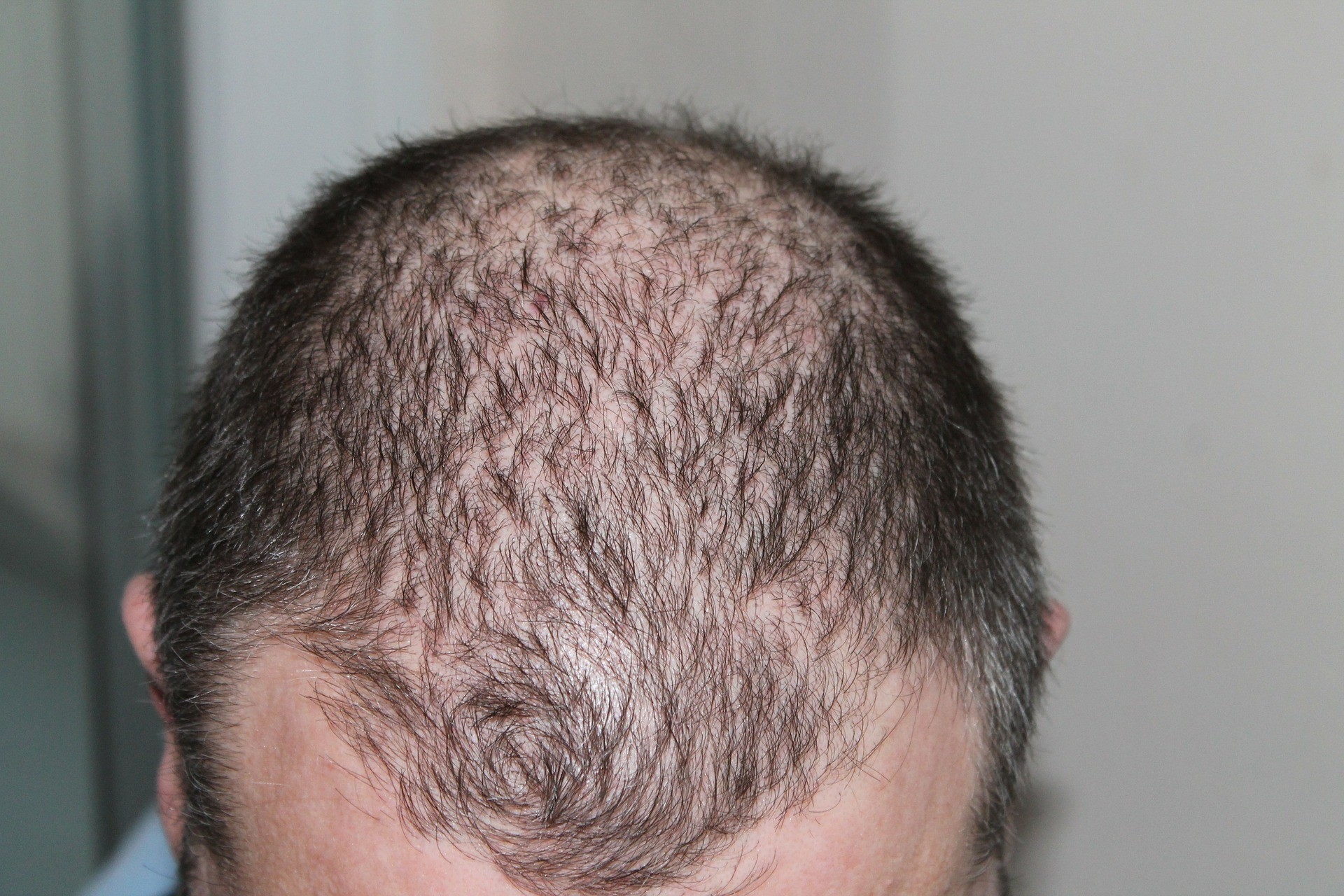 Poluio do ar tem relao com queda de cabelo