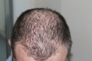 Poluio do ar tem relao com queda de cabelo