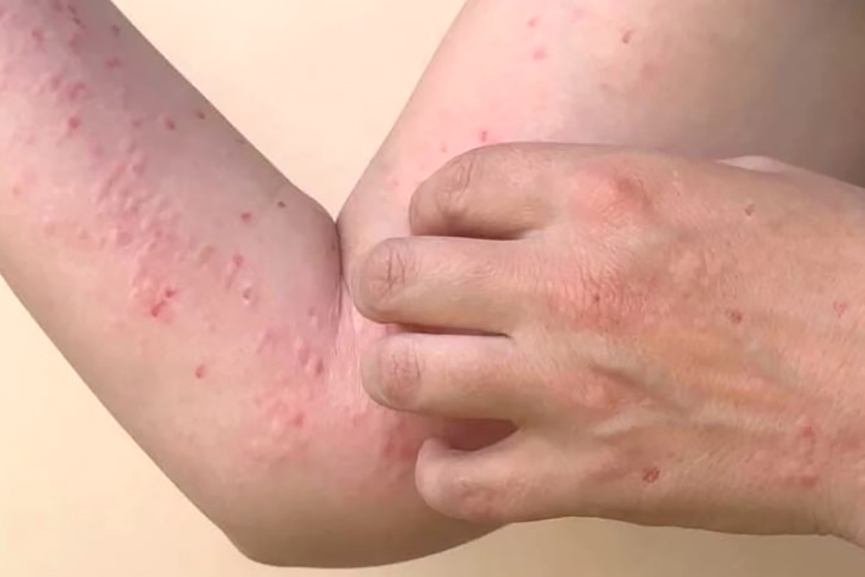 Gaspar soma tr�s casos confirmados da var�ola dos macacos