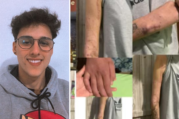 Jovem de Gaspar pede ajuda para realizar cirurgia de urg�ncia e voltar a movimentar o bra�o