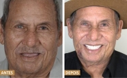 Idoso de Timbó faz cinco dentaduras e sofre para se alimentar até encontrar solução em clínica em Gaspar