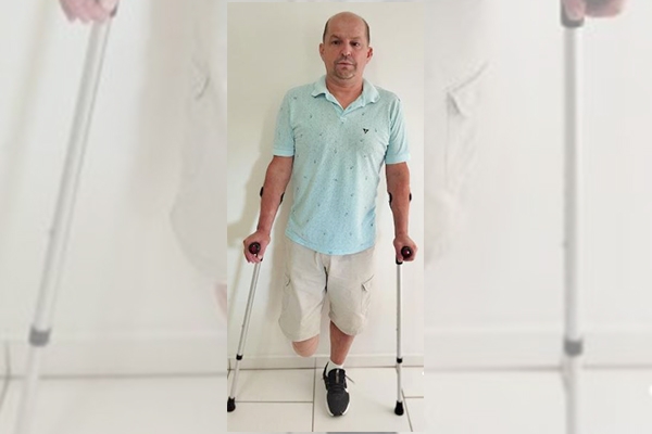 Morador do Coloninha pede ajuda para comprar prótese