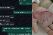 Madrasta � presa ap�s queimar m�o de enteada de prop�sito em Itaja�
