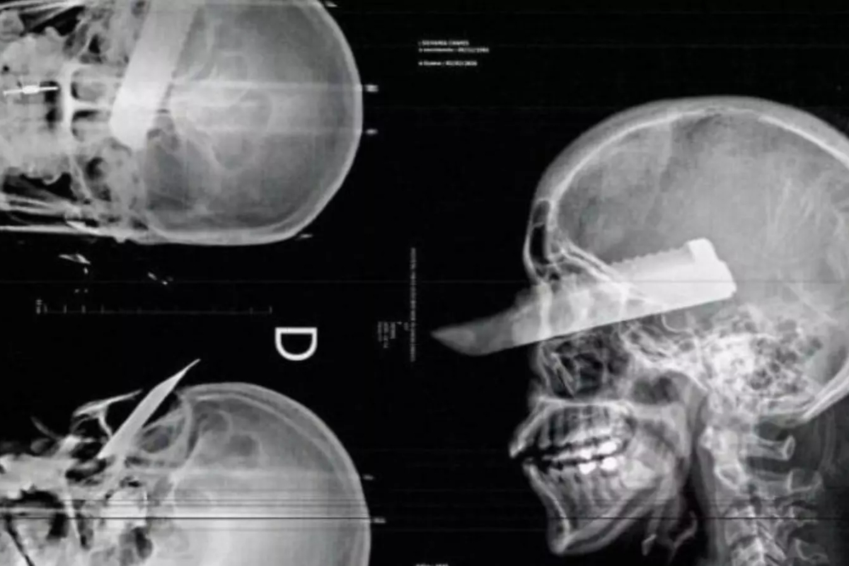 Mulher fica cega de um olho ap�s ser esfaqueada pelo marido no Oeste de SC